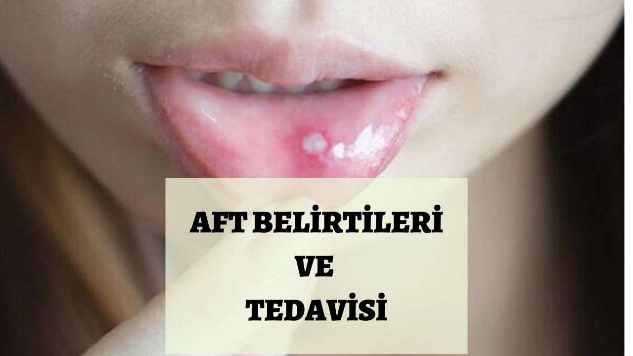 Photo of Aft Belirtileri ve Tedavisi